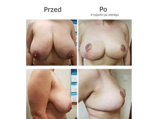 Przed i po - lifting biustu