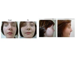 Przed i po - rhinoplastyka