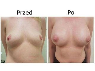 Przed i po - powiększanie biustu