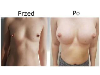 Przed i po - powiększanie biustu