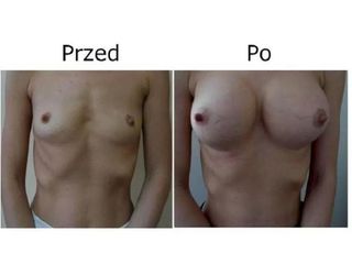 Przed i po - powiększanie biustu