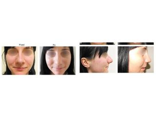 Przed i po - rhinoplastyka
