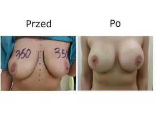 Przed i po - powiększanie piersi i mastopeksja