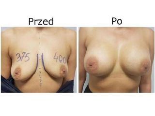 Przed i po - powiększanie piersi