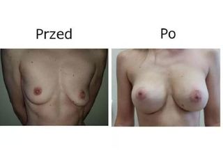 Przed i po - powiększanie biustu
