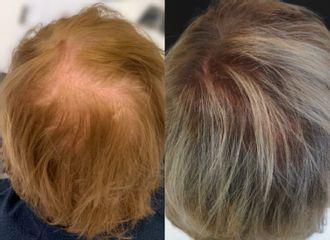 Przeszczep włosów u kobiet - przed i po