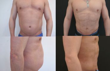 Liposukcja - przed i po