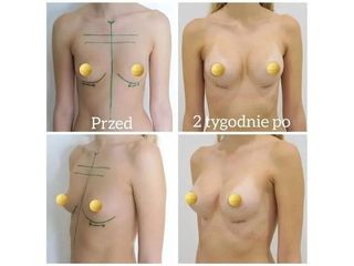Powiększanie piersi - przed i po
