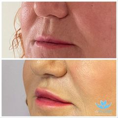 Powiększanie ust - Korekta nosa - Wodzisławskie Centrum Medyczne