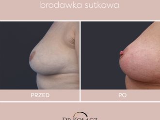 Wciągnięte brodawki przed i po - 851599