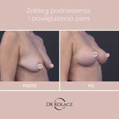 Dr n. med. Szymon Kołacz - podniesienie piersi wraz z wszczepieniem implantów piersiowych