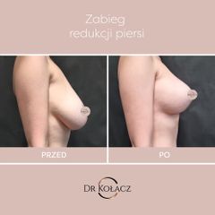 Zmniejszenie biustu - Dr n. med. Szymon Kołacz
