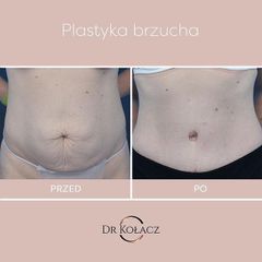 Plastyka brzucha - Dr n. med. Szymon Kołacz