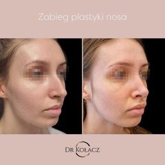 Korekta nosa - Dr n. med. Szymon Kołacz