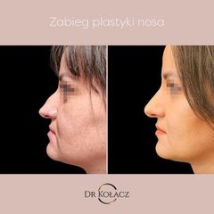 Korekta nosa - Dr n. med. Szymon Kołacz