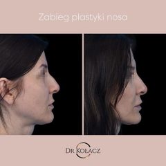 Korekta nosa - Dr n. med. Szymon Kołacz