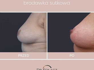 Wciągnięte brodawki przed i po - 867292