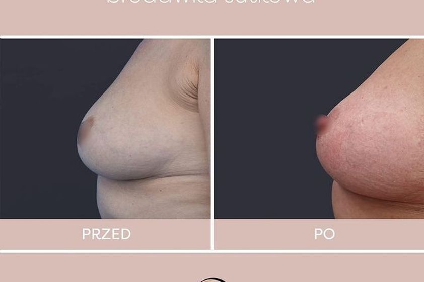 Wciągnięte brodawki przed i po - 867292
