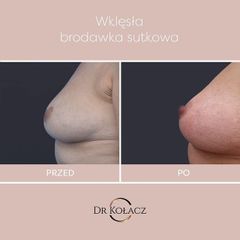 Wciągnięte brodawki - Dr n. med. Szymon Kołacz