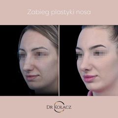 Korekta nosa - Dr n. med. Szymon Kołacz