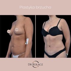 Plastyka brzucha - Dr n. med. Szymon Kołacz