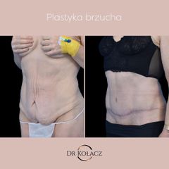 Plastyka brzucha - Dr n. med. Szymon Kołacz