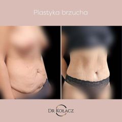 Plastyka brzucha