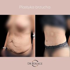 Plastyka brzucha
