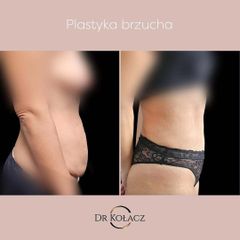 Plastyka brzucha