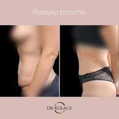 Plastyka brzucha