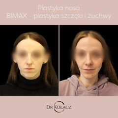 Plastyka nosa