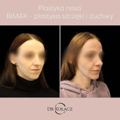 Plastyka nosa