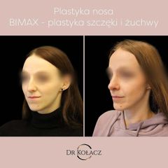 Plastyka nosa