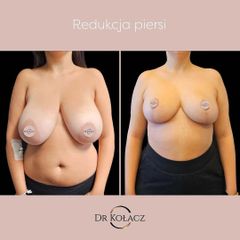 redukcja piersi