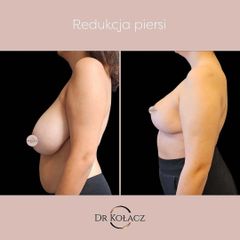 redukcja piersi