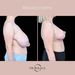 redukcja piersi