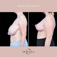 redukcja piersi