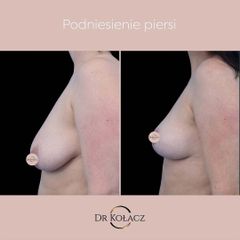podniesienie piersi