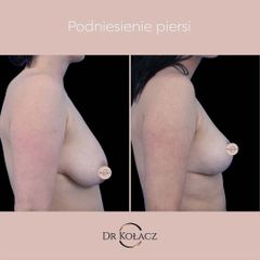podniesienie piersi