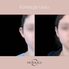 korekcja uszu