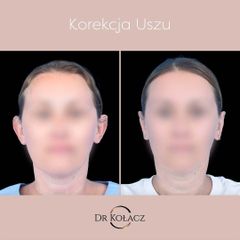 korekcja uszu Dr n. med. Szymon Kołacz