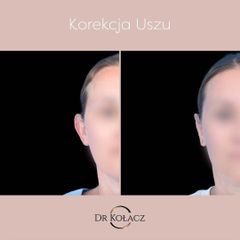 korekcja uszu Dr n. med. Szymon Kołacz