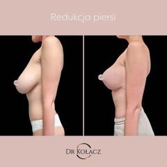 Redukcja piersi Dr n. med. Szymon Kołacz