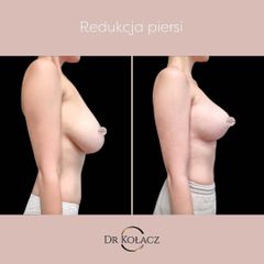 Redukcja piersi Dr n. med. Szymon Kołacz