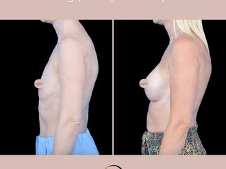 Powiększanie biustu przed i po - 876508