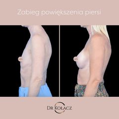 Zabieg powiększenia piersi