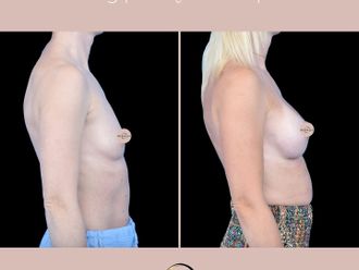 Powiększanie biustu przed i po - 876509