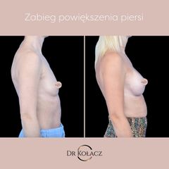 Zabieg powiększenia piersi