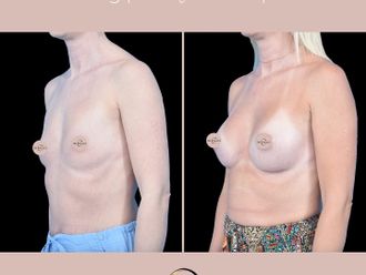 Powiększanie biustu przed i po - 876510