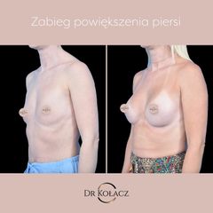 Zabieg powiększenia piersi